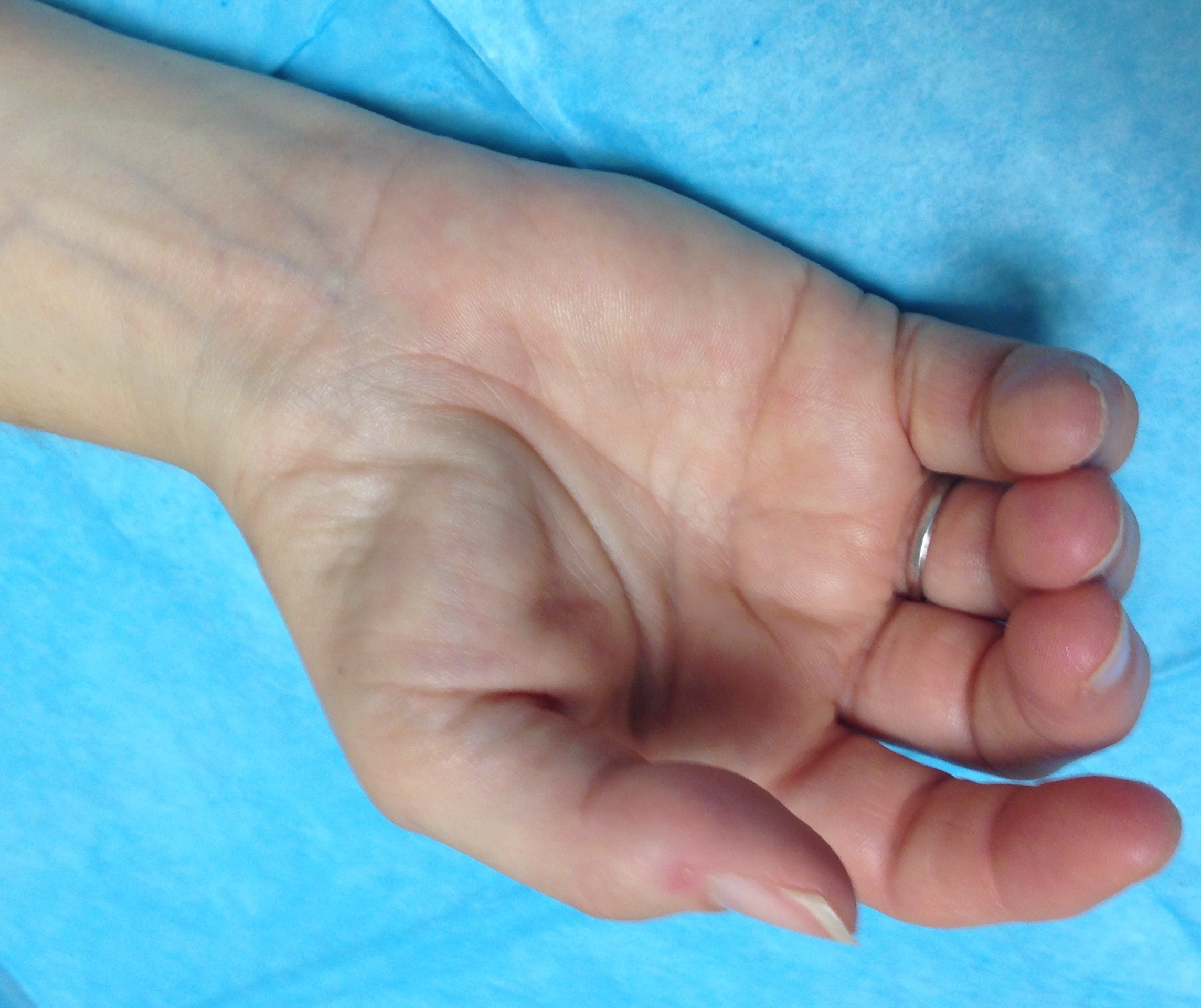 Thenar Muscle Atrophy Hand Surgery Resource — free download
